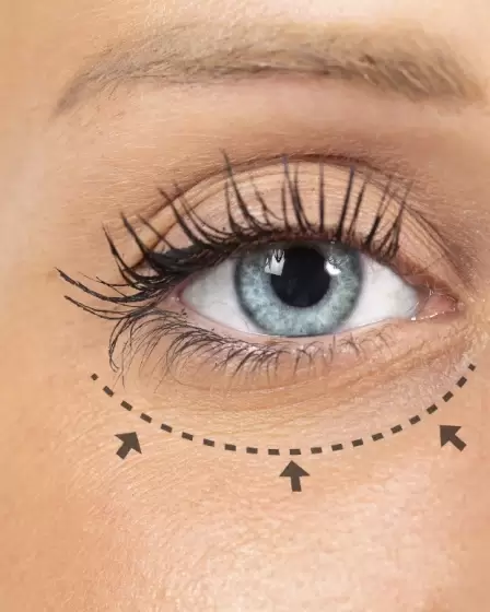 spodnja-blefaroplastika