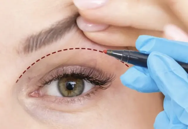 Blefaroplastika omogoča dolgoročno mladosten videz